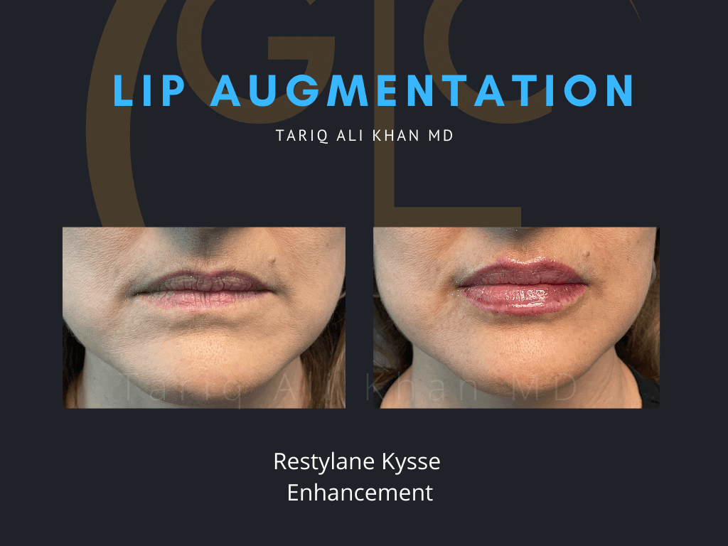 Gentle Care Laser Tustin & Long Beach Before and After picture - Lip Augmentation